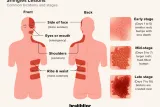 Shingles, Stress, and Startup Life