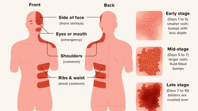 Shingles, Stress, and Startup Life
